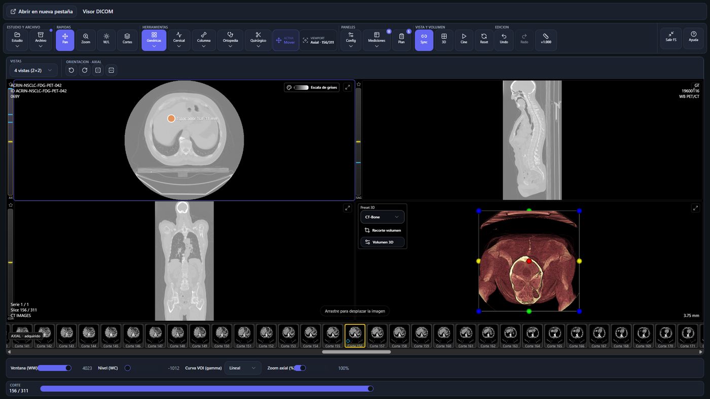 Visor clínico de VARMAN en cuatro vistas: axial, sagital, coronal y reconstrucción 3D